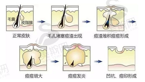 郑州激光治疗痘坑痘印好医院推荐这十家