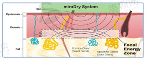 miradry清新微波治疗原理