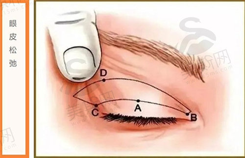 眼皮松了适合做提眉还是割双眼皮