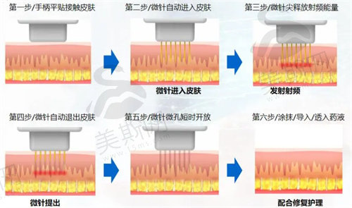 黄金微针的功效和作用