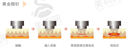 黄金微针价格一般是多少？