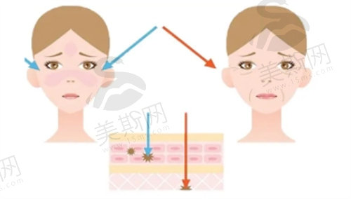 埋线提升面部有什么副作用？
