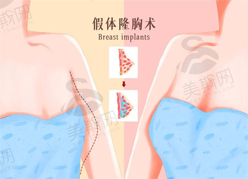 假体取出来胸部是什么样子