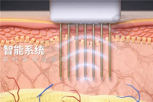 黄金微针有什么好处？