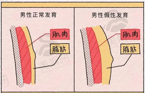 怎么区分男性乳房发育肥大和肥胖