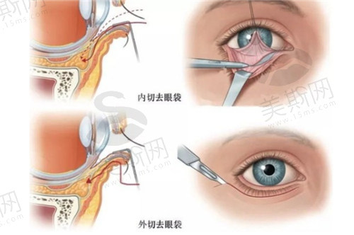 内切祛眼袋和外切祛眼袋有什么区别？