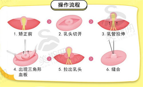 乳头内陷矫正手术大概多少钱