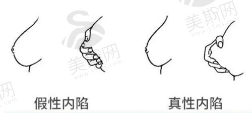 乳头重度内陷怎么矫正