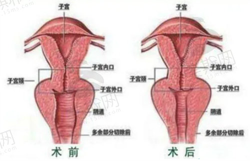 盐城友谊整形所缩阴手术怎么样？