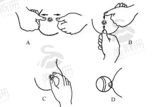 乳头内陷矫正方法