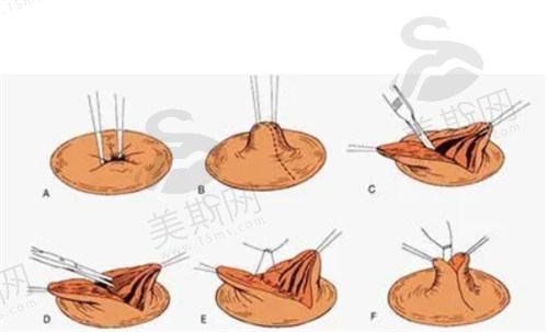 天生乳头内陷可以通过手术矫正吗？