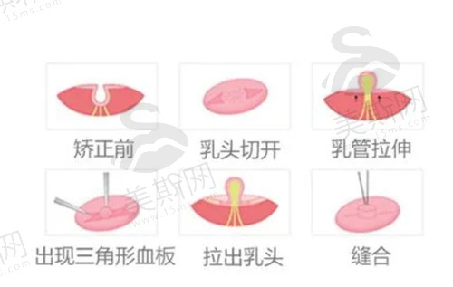 乳头内陷矫正术大概多少钱？