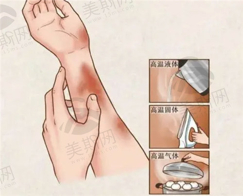 烫伤疤痕修复的方式有哪些？
