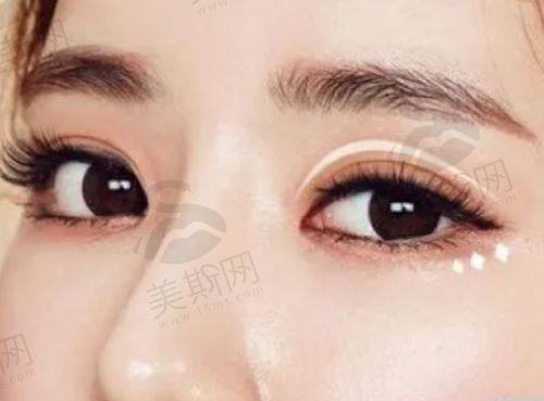 做眼袋内吸多久可以洗脸化妆