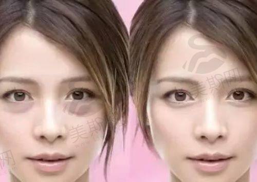 做眼袋内吸多久可以<span style=