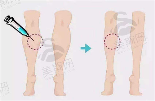 大腿吸脂前需要做什么准备