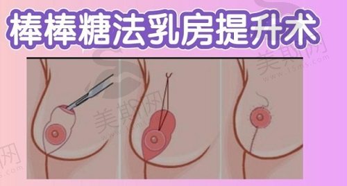 乳房悬吊提升手术可以保持多久