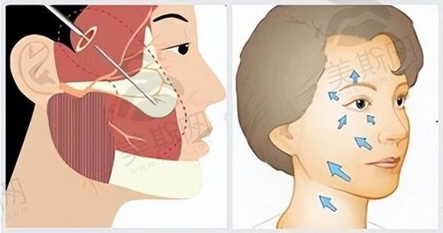 微拉美和拉皮手术有什么区别