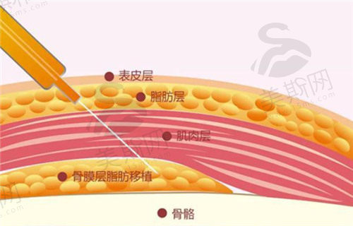 自体脂肪丰臀手术费大概要多少钱