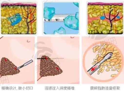 超脂塑体雕术与传统抽脂的区别