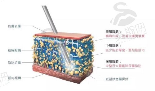 超脂塑体雕术与传统抽脂的区别