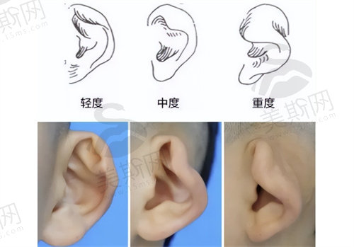 杯状耳有必要矫正吗