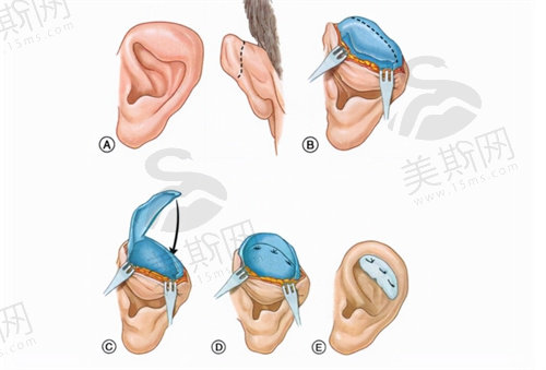 杯状耳矫正手术方式具体价格