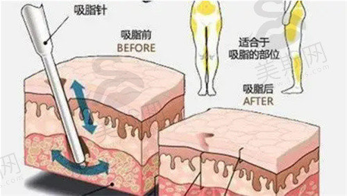 、南京康美张让虎做腰腹环吸折角腰的技术很不错