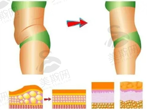 、南京康美张让虎做腰腹环吸折角腰备受喜爱