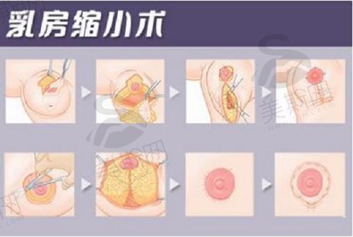 缩胸手术一般什么年龄段适合做