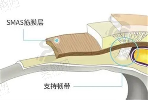 筋膜悬吊提升术恢 复期多久