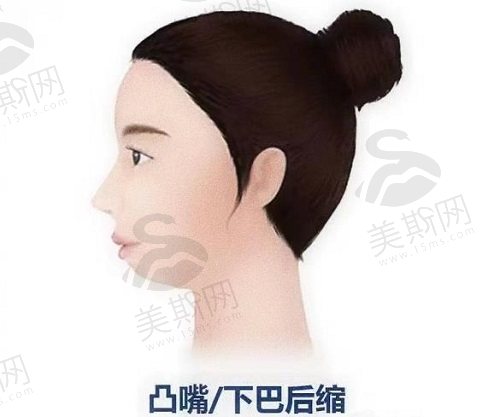 下巴后缩和双下巴的形成原因