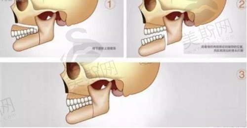下巴后缩双下巴明显怎么改善