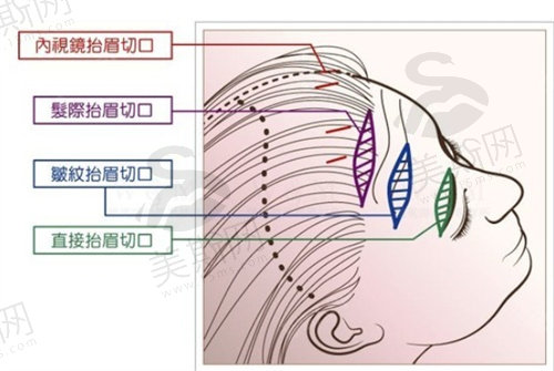 无痕切眉术会留疤痕吗