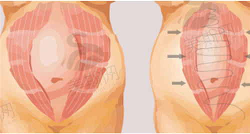 腹壁整形手术多久可以修养好