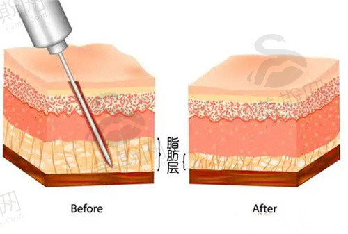 广州军美王世虎做吸脂怎么样