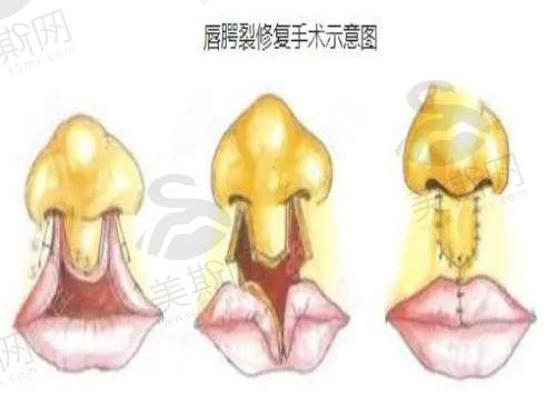 兔唇修复手术什么时候做适合