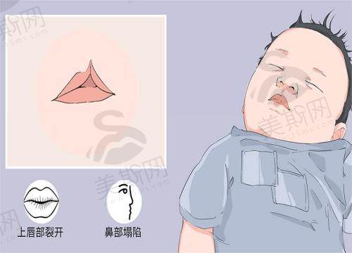 兔唇修复手术什么时候做适合