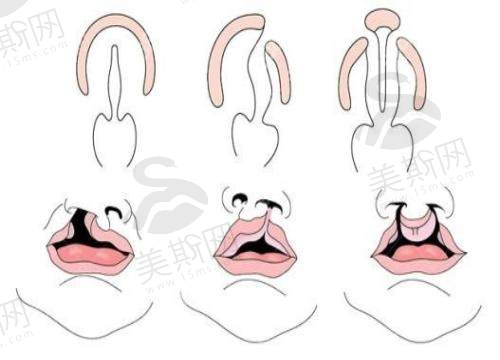 兔唇修复手术什么时候做适合