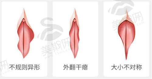 小阴唇长于大阴唇怎么改善?