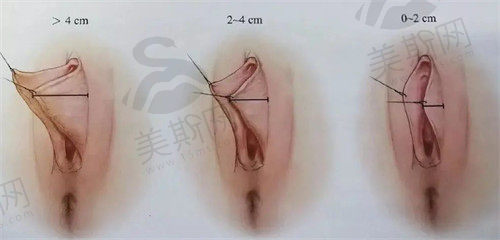 阴唇长度
