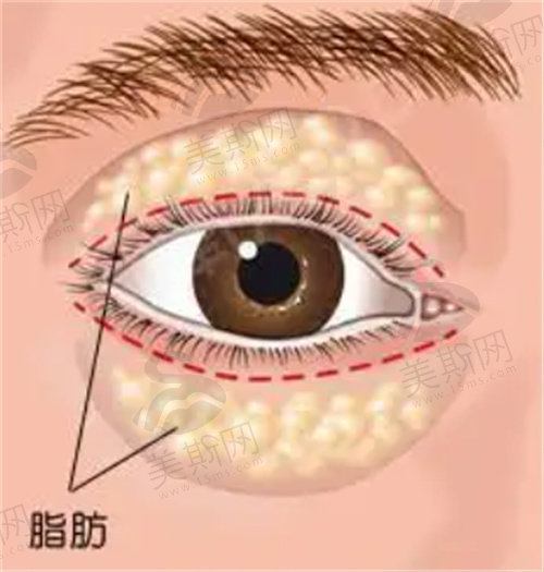 深圳健丽医院:眼袋微创手术怎么样？