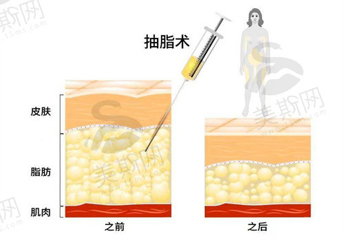 5g光雕跟水动力吸脂哪个好