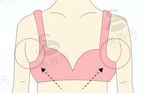 怎样才可以消除副乳