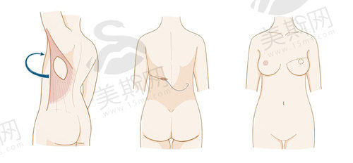 什么是乳房再造手术