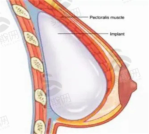 乳房再造手术缺点和优点各多少
