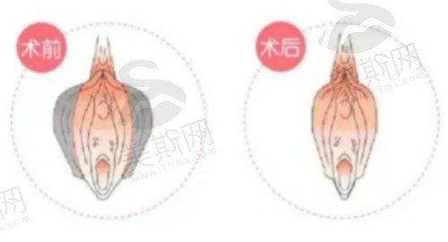 北京嘉禾整形医院做私密整形手术口碑不错