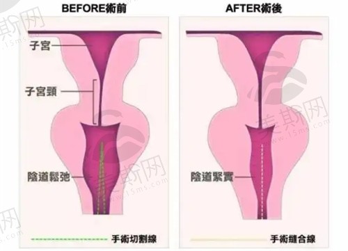 北京嘉禾整形医院李燕医生做私密技术出色