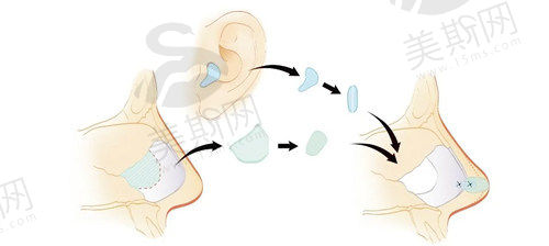 自体肋软骨隆鼻后遗症