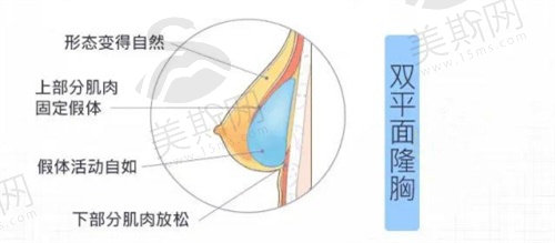 深圳南雅刘富增做的花苞提升术改善下垂胸部